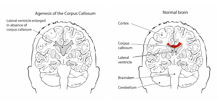 Agensis of the Corpus Callosum