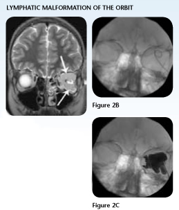 Case Study 2 Orbital Lymphatic Malformation