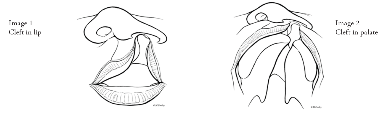 Examples of Cleft Lip and Palate