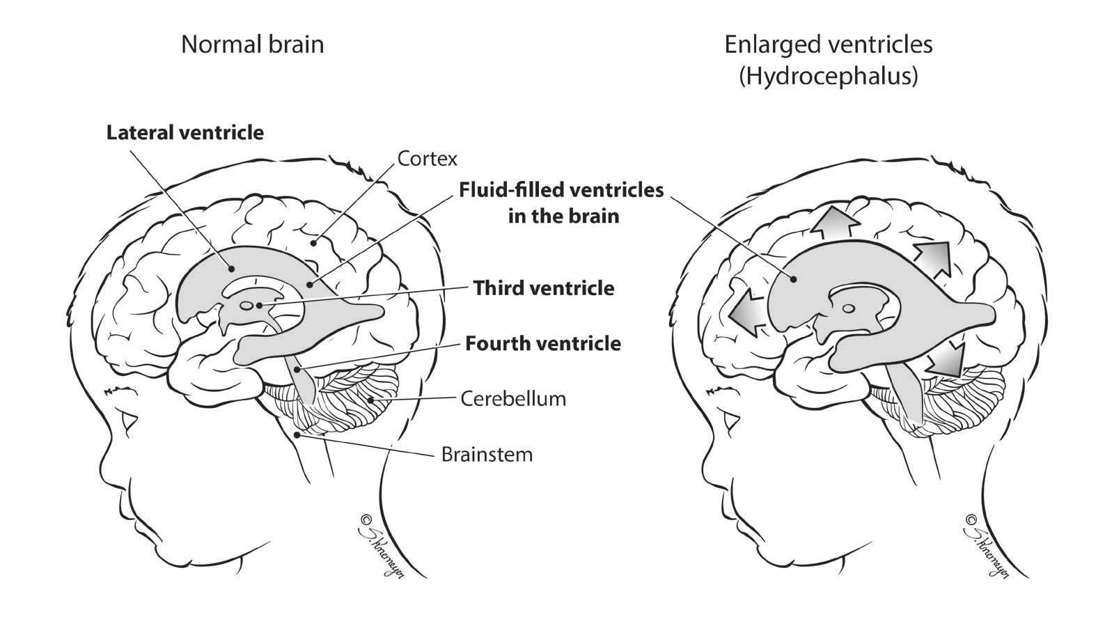 Dandy-Walker Syndrome
