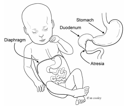 Duodenal Atresia