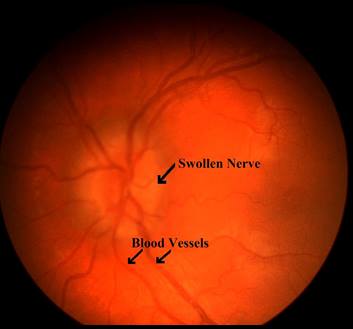 eye with intracranial hypertension