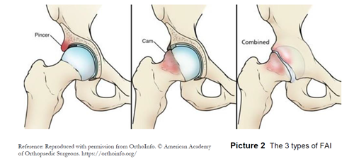 3 types of FAI: Pincer, Cam and Combo