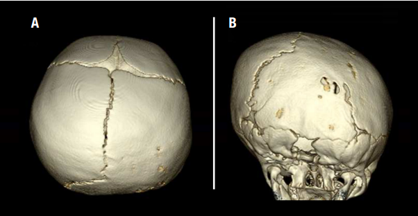 lambdoid craniosynostosis