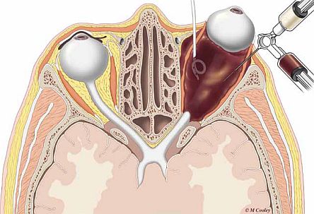 lymphatic malformation cyst