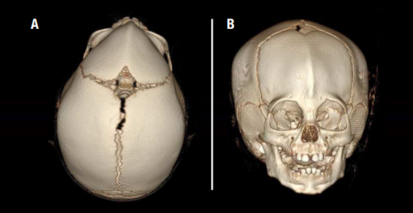 metopic craniosynostosis