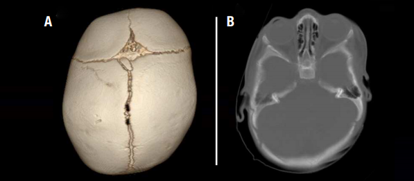 positional plagiocephaly