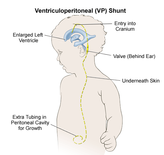 Ventriculoperitoneal shunt 