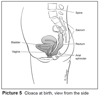 Cloaca at birth, view from the side