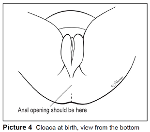 Cloaca at birth, view from the bottom