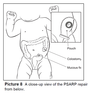 A close-up view of the PSARP repair from below.