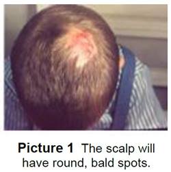 ringworm rash on the scalp of child
