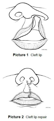cleft lip repair