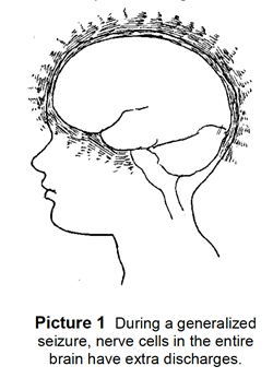 During a generalized seizure, nerve cells in the brain have extra discharge 