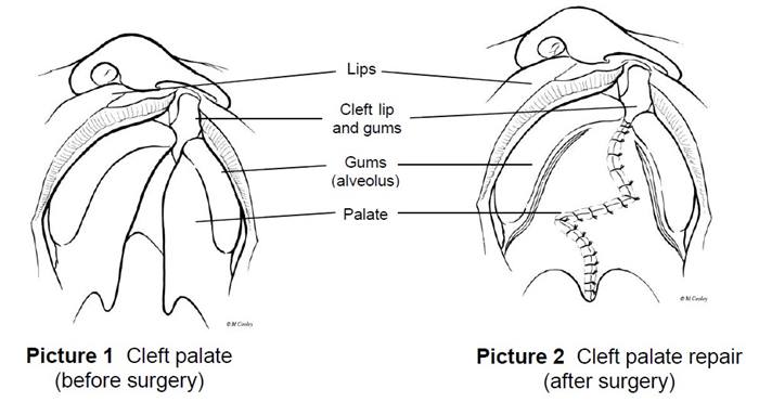 protecting the cleft palate repair