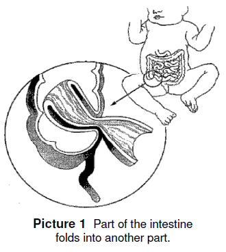 part of the intestine folds into another part