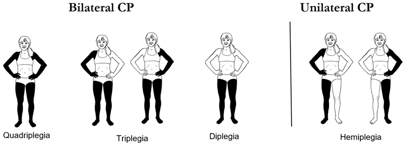 Limbs involved in cerebral palsy 