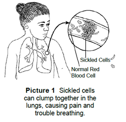Sickle Cell Disease