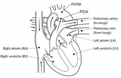 A heart with the patent ductus arteriosus still open