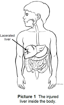 Line drawing of a child with a lacerated liver.