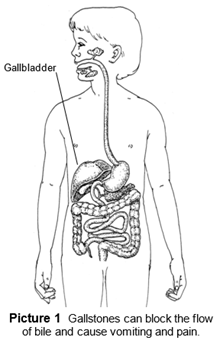 Picture of child showing that gallstones can block the flow of bile and cause vomiting and pain.