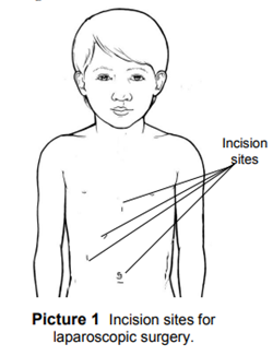Incision sites for laparoscopic surgery