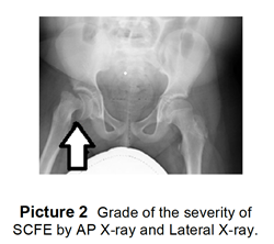 Grade of the severity of SCFE by AP X-ray and Lateral X-ray
