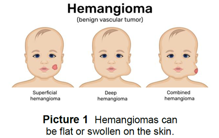 the 3 types of hemangiomas on a baby's face