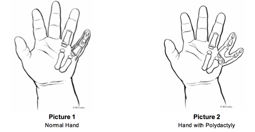 normal hand and hand with polydactyly