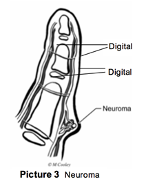 Neuroma