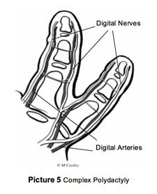 Complex Polydactyly