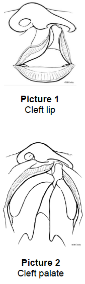 Depiction of cleft lip and cleft Palate