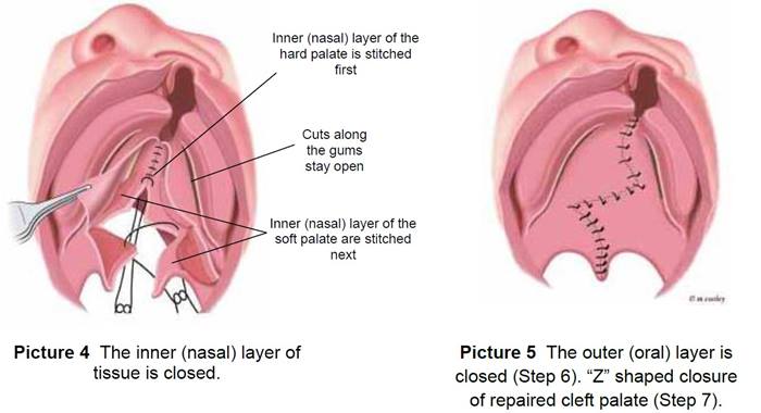 closing the inner layer and the outer layer