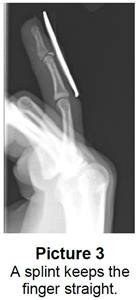 x ray of finger with a splint