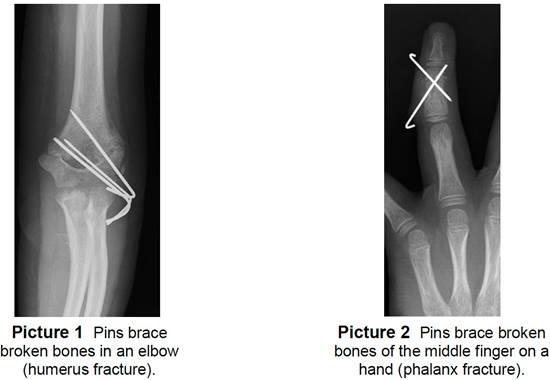 a pinned elbow and finger