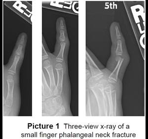 Phalangeal Neck (Finger) Fracture