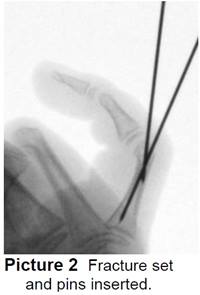 Phalangeal Neck (Finger) Fracture