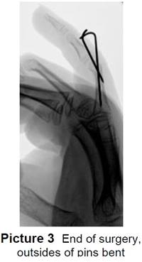 Phalangeal Neck (Finger) Fracture