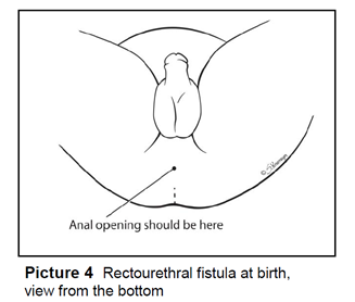 Rectourethral fistula, view from the side