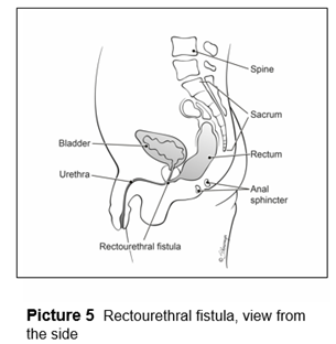 Rectourethral fistula, view from the side