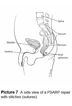 A side view of a PSARP repair with stitches (sutures).