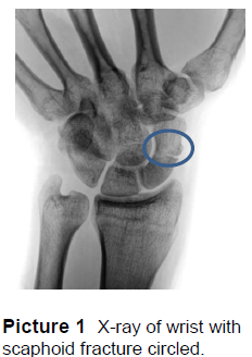 X-ray of wrist with scaphoid fracture circled