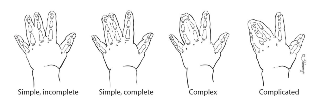 Picture of the different types of Syndactyly discussed