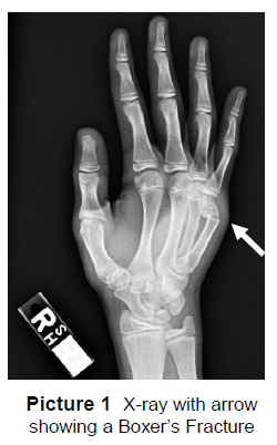 X-ray with arrow showing Boxer's Fracture
