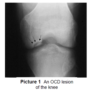 An OCD legion of the knee
