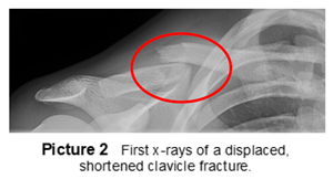 Displaced, shortened clavicle fracture x ray