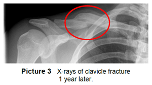 X ray of clavicle fracture