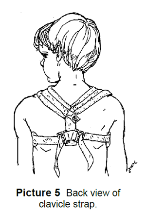 Back view of clavicle strap