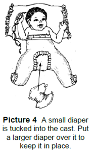 A small diaper is tucked into the cast. A larger diaper should be secured around the cast.