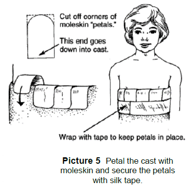 moleskin is used to petal the cast